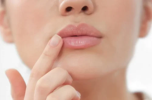 Hyaluronzuur fillers- De sleutel tot vollere, natuurlijke lippen