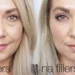 Bye Bye Puffiness: Discover the Benefits and Risks's of Fillers for Bags Under Eyes