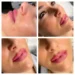 Discover the Secrets of Russian Lip Fillers: Cheap and Effective!