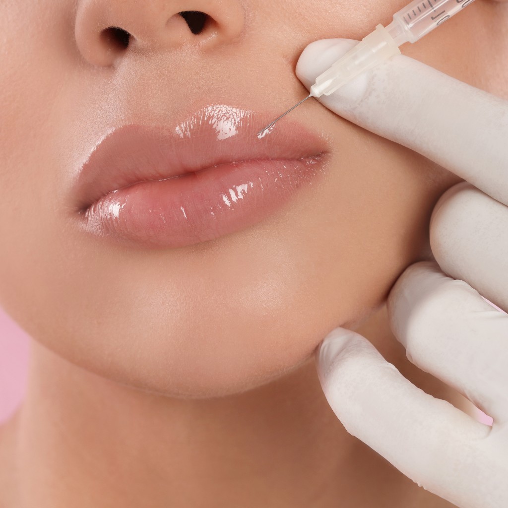 Découvrez la magie de l'acide hyaluronique dans les traitements de comblement des lèvres