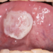 Ulcerations and Erosions of the Oral Mucosa