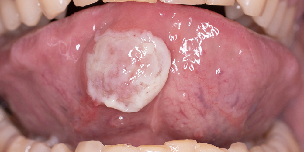 Ulcerations and Erosions of the Oral Mucosa