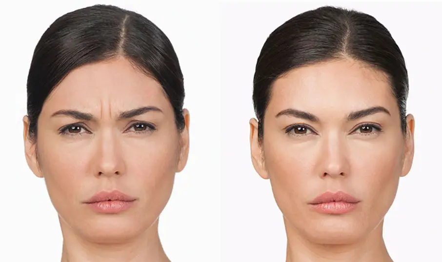 Op de foto is een close-up te zien van het voorhoofd en de wenkbrauwen van een vrouw voor en na de behandeling. In het ‘voor’-beeld tekenen zich duidelijke fronsrimpels en een licht hangende wenkbrauwlijn af, terwijl het ‘na’-beeld een zichtbaar gladde huid en een subtiel gelifte wenkbrauwboog laat zien. Deze transformatie illustreert perfect het effect van een botox wenkbrauwlift, een populaire injectable in cosmetische klinieken voor huidverbetering en esthetische verjonging. Dankzij deze professionele aanpak ontstaat er een frisse, open blik zonder ingrijpende ingreep.