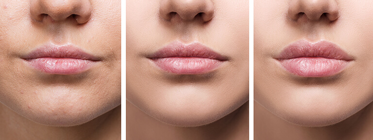 Op de afbeelding zie je in drie stappen een close-up van de lippen voor, direct na en enkele dagen na een behandeling met lip filler 0.5 ml. De subtiele toename in volume en symmetrie benadrukt hoe een klein injecteerbaar product een natuurlijke en frisse look kan geven. De huid rond de lippen oogt glad en egaal, wat de precisie en zorg van een professionele kliniek illustreert. Deze cosmetische behandeling sluit naadloos aan bij huidverbetering en esthetische wensen zonder overweldigend resultaat. Door de focus op 0.5 ml filler toont het beeld hoe minimaal ingrijpen maximale verfijning kan bieden.
